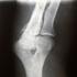 Niektóre regiony genów mogą być związane z osteoporozą