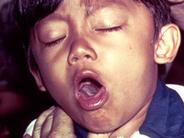 Krztusiec (koklusz) u dzieci – objawy, przebieg choroby, profilaktyka, leczenie, powikłania