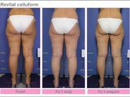 Nowa terapia antycellulitowa Nowa terapia antycellulitowa