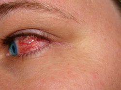 Sprawdź, jakie są najczęstsze przyczyny przekrwienia oczu!