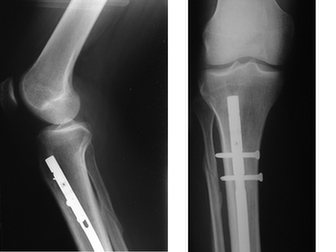 Zdjęcie rentgenowskie ukazujące bliższą część złamanej kości piszczelowej z gwoździem śródszpikowym