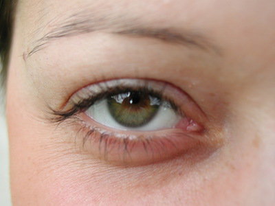 Najczęstsze choroby oczu