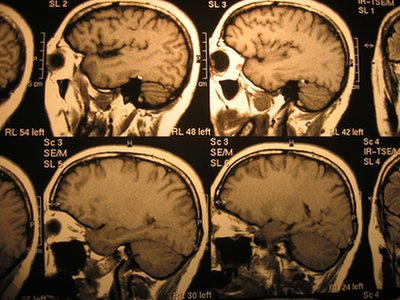 Witamina C zmniejsza ryzyko wystąpienia udaru mózgu