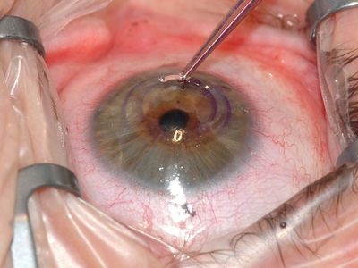 Przeszczep łożyska pozwala wyleczyć uszkodzoną rogówkę oka