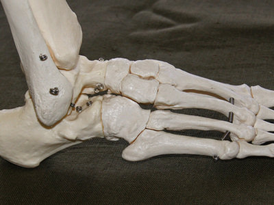 Nowe badania pomogą w opracowaniu lepszych protez