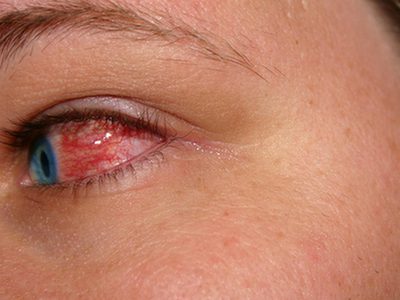 Problemy ze wzrokiem podczas upałów