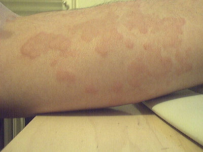 Mały alergik, czyli jakie rodzaje alergii mogą zagrażać malcowi?