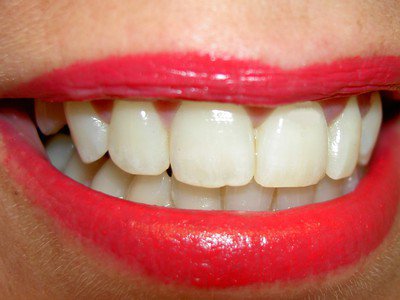 Przeciwwskazania do wybielania zębów
