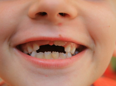 Próchnica zębów i nieprawidłowy zgryz u małego dziecka