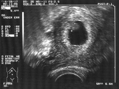 Próba wyeliminowania istnienia "chłopczyc", hermafrodytów oraz lesbijek: terapia sterydowa we wczesnej fazie prenatalnej